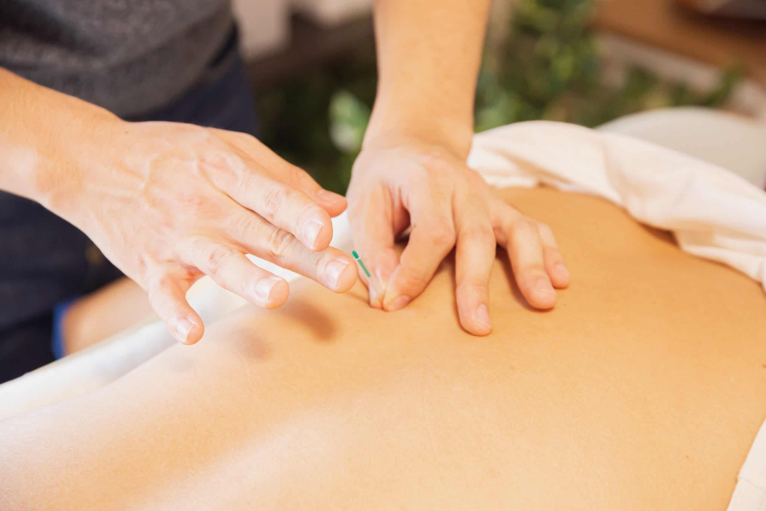 Close-up of a practitioner’s hands inserting a thin acupuncture needle into a person's bare back during a treatment session