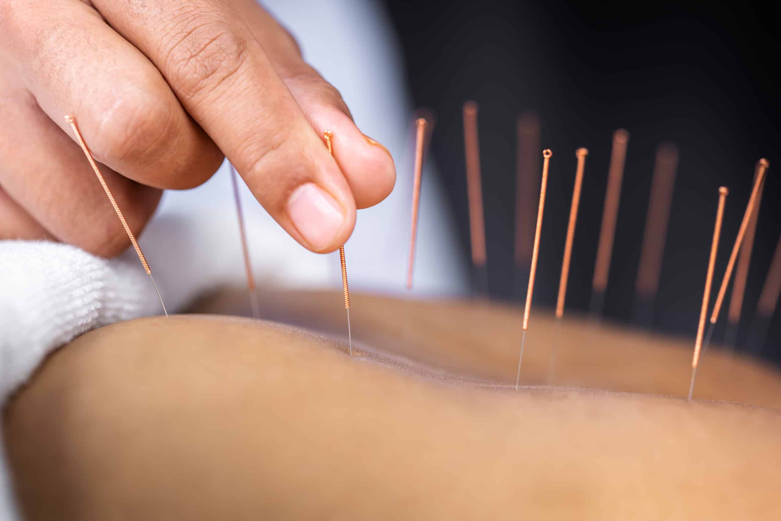 Acupuncture for depression