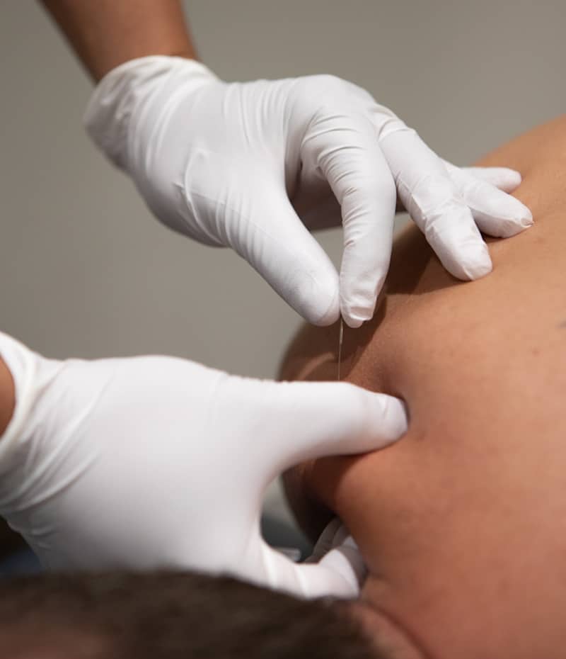 physio langley ims or dry needling