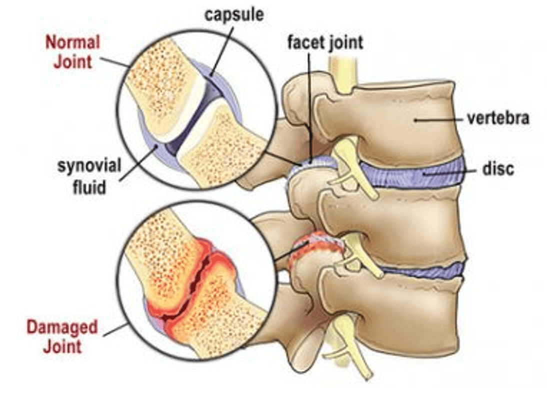 facet joint irritation